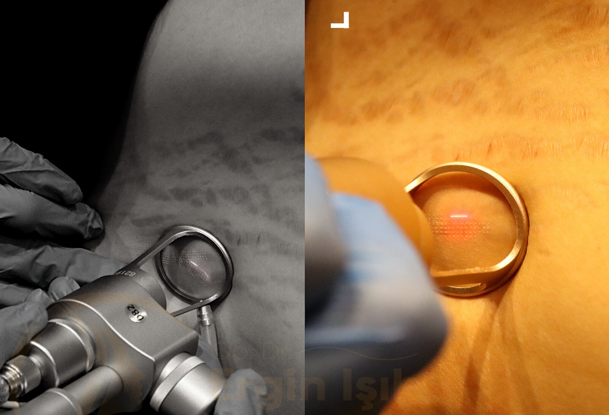 FRACTIONAL LASER TREATMENT